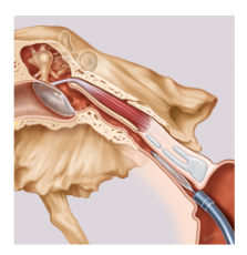 Eustachian tube hot sale and tinnitus